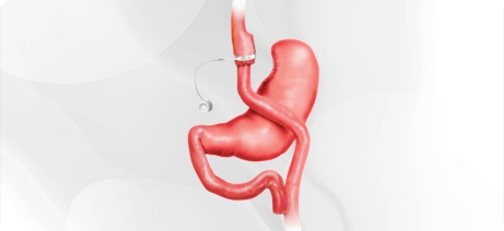 Gastric Bypass Surgery